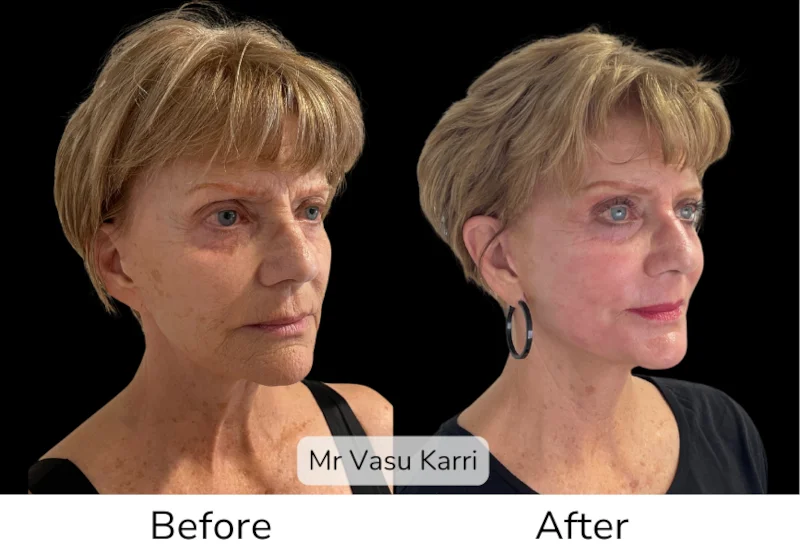 Facelift Patient 2 View 3